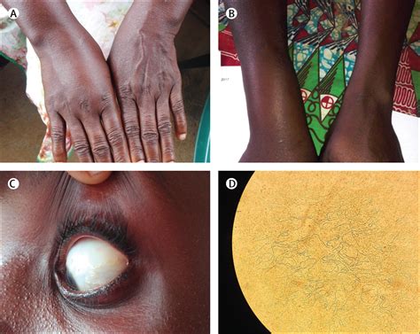 Burden of disease in Gabon caused by loiasis: a cross-sectional survey ...