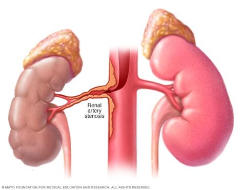 Renal artery stenosis - Symptoms and causes - Mayo Clinic