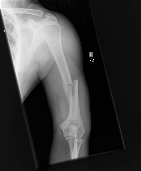 Humeral Shaft Fractures Trauma Orthobullets | Free Nude Porn Photos