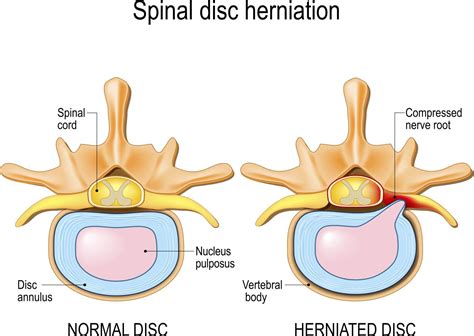 Cervical Radiculopathy and Herniated Disc | Antonio Webb - Neck, Back ...