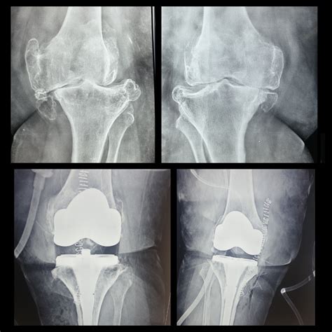 Single-Stage Bilateral Total Knee Replacement Surgery Success - Knee ...