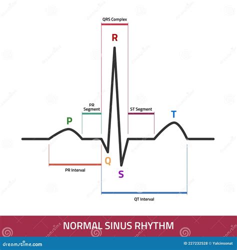 Ekg Muestra Una Onda De Latido Normal. Diagrama De Infografía De Ritmo ...