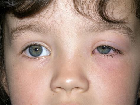 Periorbital cellulitis | BabyCenter