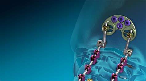 Medtronic spinal product gets FDA clearance - Memphis Business Journal