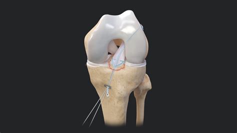 Arthrex - FiberRing™ Sutures