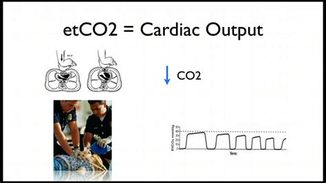 Capnography in Cardiac Arrest - YouTube