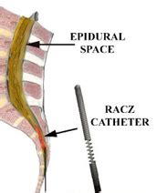 Lysis of Adhesions - Racz Catheter - Midland Spine Institute