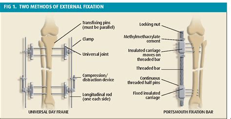 Figure 1 from Psychosocial issues relating to external fixation of ...