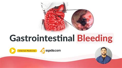 Gastrointestinal Bleeding | Medicine Online Education | Medical ...