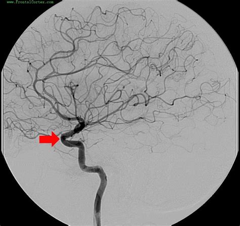 Image: Angiogram ICA Cavernous