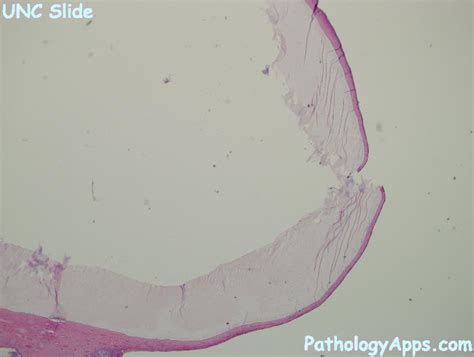 nabothian cyst cervix histology