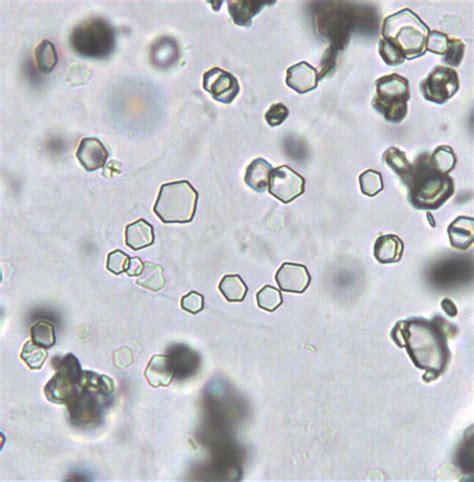 Cystine crystals showing colorless, refractile, and hexagonal plates ...