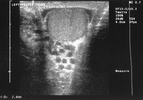 RadiologySpirit: varicocele