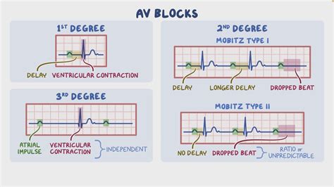 Arrhythmias - Heart blocks: Nursing - Osmosis Video Library