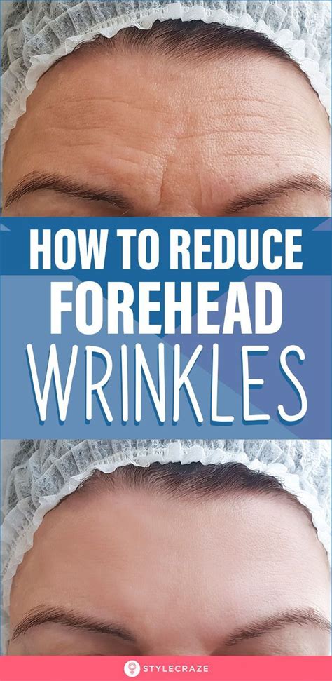 How To Get Rid Of Forehead Wrinkles: 10 Home Remedies in 2021 | Reduce ...