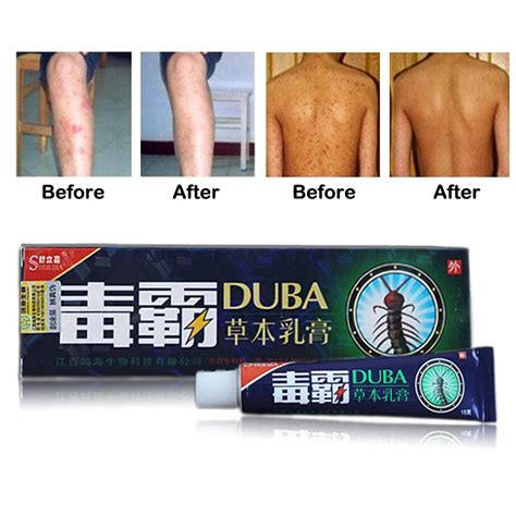 Body Psoriasis Cream Perfect For Dermatitis and Eczema Pruritus ...