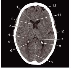 Head CT anatomy | Radiology Key