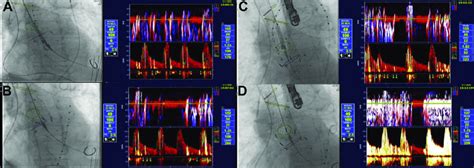 Live fluoroscopy and corresponding intraoperative transcranial Doppler ...