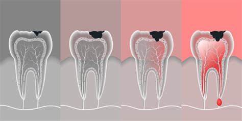 Causes and treatment of dental caries | blog now