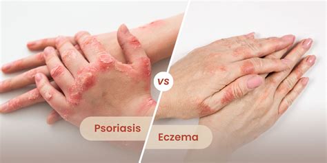 Psoriasis vs. Eczema: Symptoms, Causes, and Treatment - Cure Natural ...