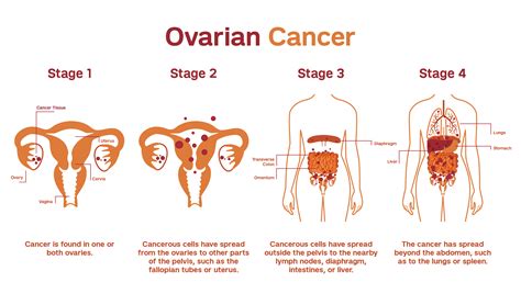 Ovarian Cancer | Patient Care