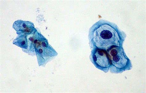 HPV/LSIL On Pap Smear | ThinPrep liquid-based Pap. Normal sq… | Flickr