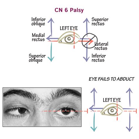 Neuroanatomy Glossary: 6th Nerve Palsy | ditki medical & biological ...