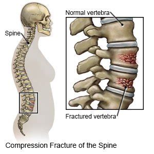 L1 Compression Fracture - Figgymcfatty