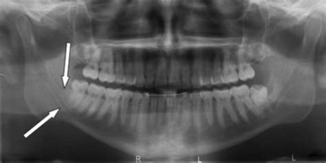 Panoramic radiograph showing the two mandibular canals | Open-i