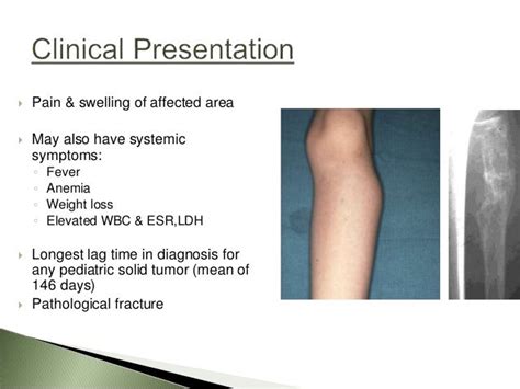 Ewing sarcoma