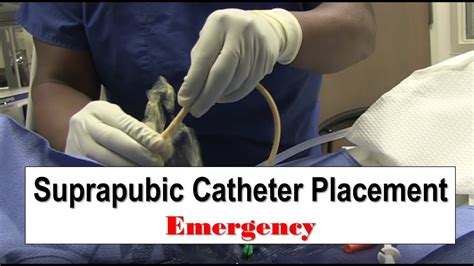 Emergency Suprapubic Catheter Placement | Doovi