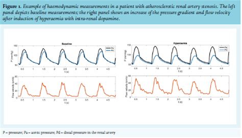 Article: New diagnostic and treatment strategies in renal artery ...