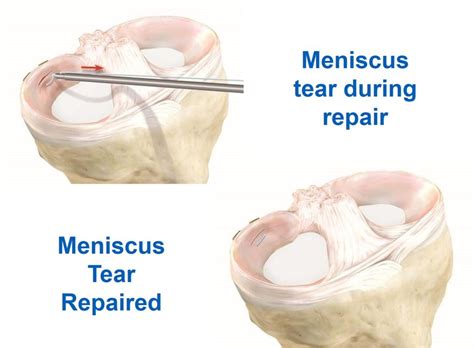 Arthroscopic Knee Surgery Meniscus Tear Video at Myrtice Matlock blog