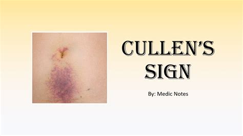 Cullen's sign/periumbilical ecchymoses - causes, pathophysiology - YouTube