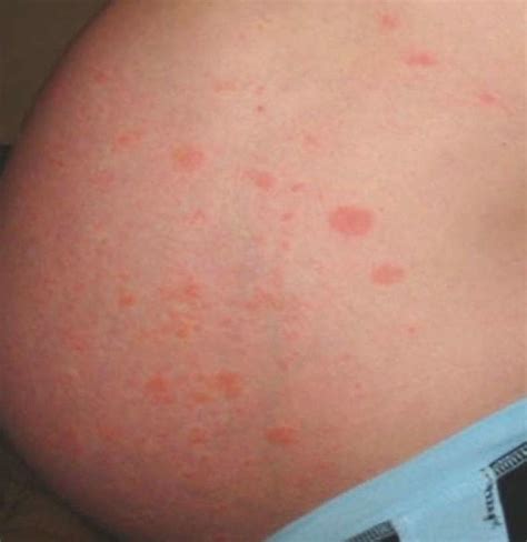 PUPPP rash in pregnancy: Natural treatments and prevention