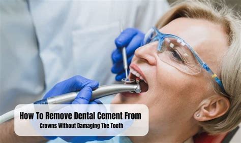 Dental Cement From Crowns Without Damaging The Tooth