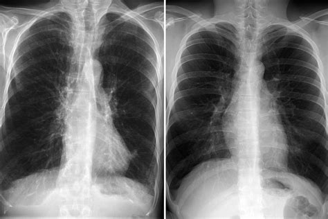 COPD Lungs vs. Normal Lungs on Medical Scans