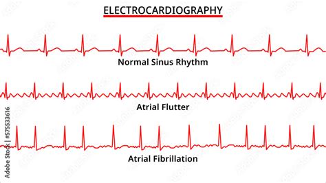 Ventricular Flutter Vs Fibrillation | The Best Porn Website