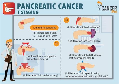 Stages Of Pancreatic Cancer