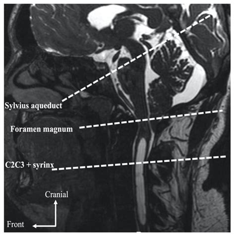 Foramen Magnum Mri