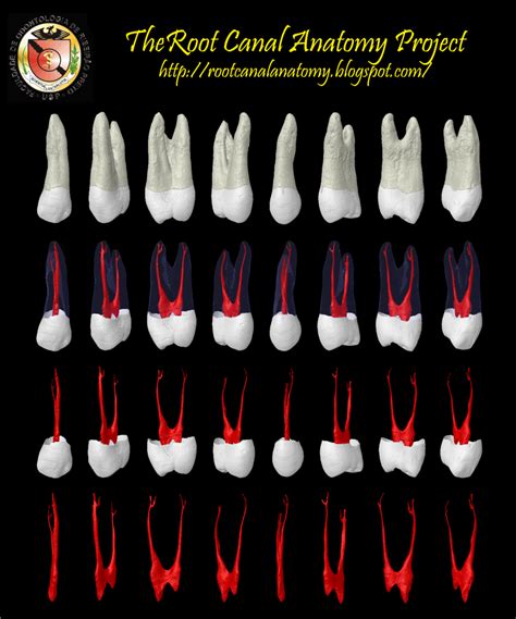 The Root Canal Anatomy Project: Maxillary First Premolar