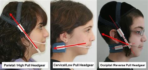 Orthodontic Headgear Types