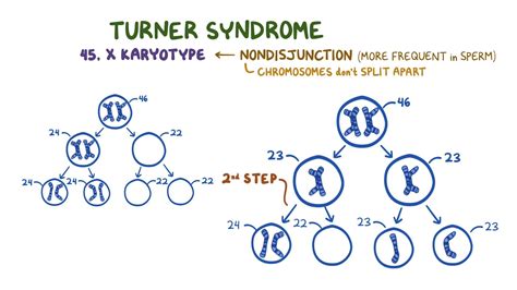 Turner syndrome: Year of the Zebra: Video & Anatomy | Osmosis