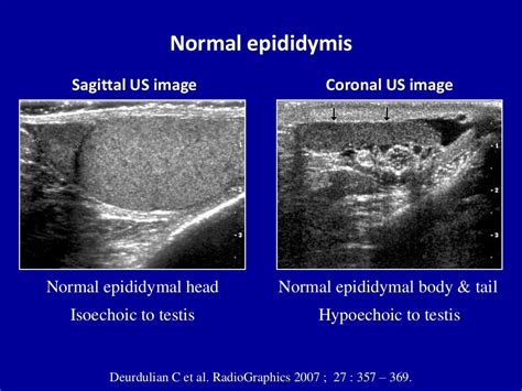 Doppler ultrasound of acute scrotum