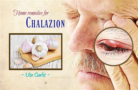 Home Eye Stye Treatment Chalazion Treatment Eyelid