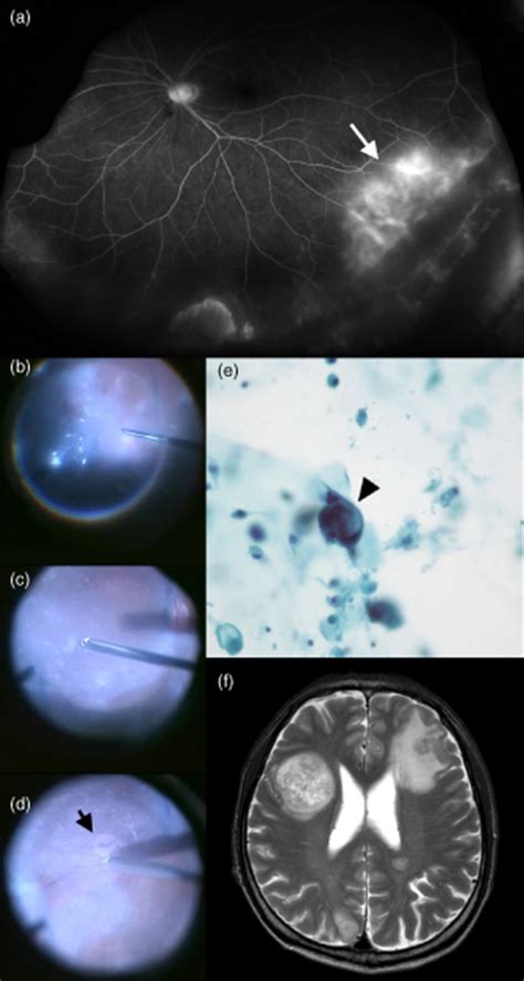 Fluorescein angiography of retina, result of vitreous b | Open-i