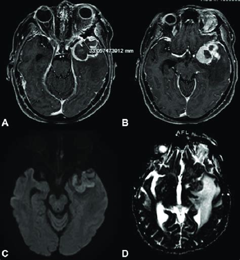 Brain MRI revealing new central restricted diffusion in the left ...