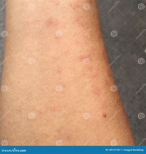 Rash Caused by Skin Allergic To Sweat, Dust and Viruses. Stock Image ...