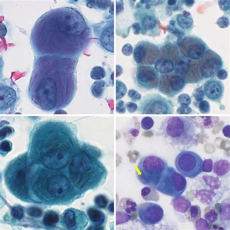 a, b Conventional cytology (Pap stain) with aggregate of mesothelial ...