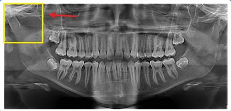 Abnormal Panoramic X Ray